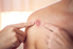 Maymun Çiçeği Virüsü (Monkeypox) Nedir? Nasıl Bulaşır?