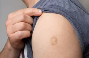 Maymun Çiçeği Virüsü (Monkeypox) Nedir? Nasıl Bulaşır?